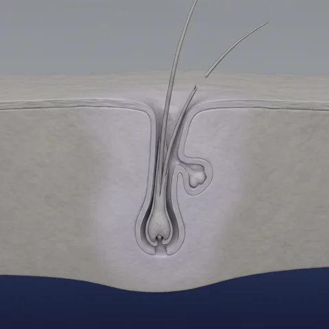 Weakened follicle with a hair coming loose from the scalp
